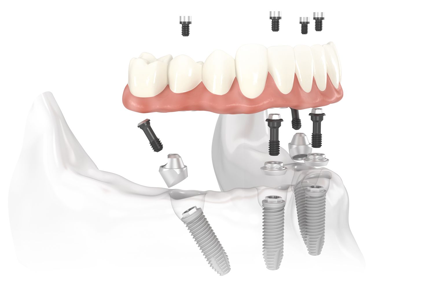 illustration of denture supported by All-on-4 implants