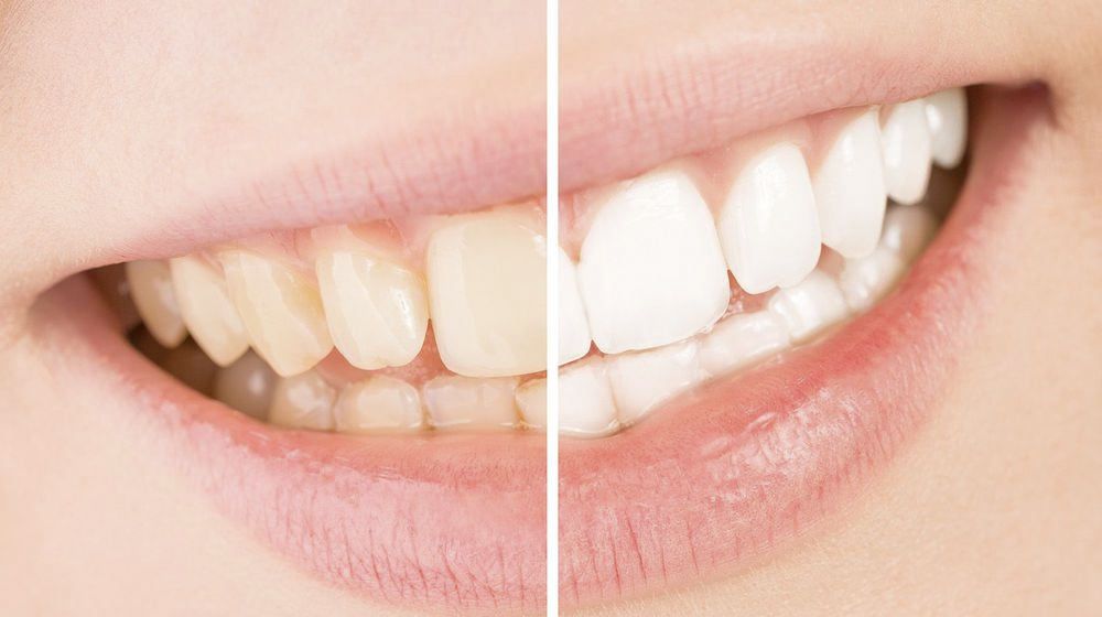 Before and after images of a teeth whitening patient.