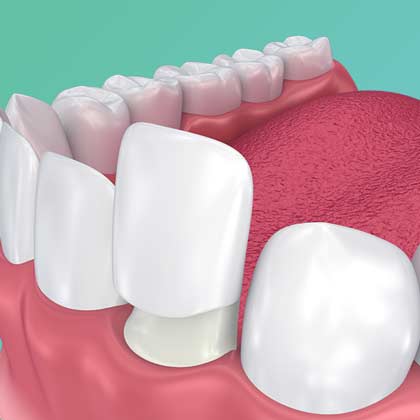 a veneer going over a tooth